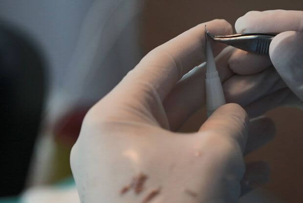 DHI Haartransplantatie