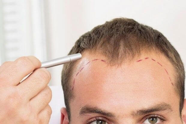 DHI Haartransplantatie