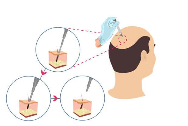 DHI Haar Transplantatie